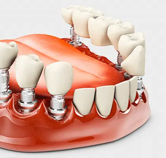 پروتز دندان در مطب دکتر مرتضی میرعالی