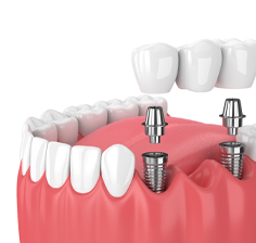ایمپلنت دندان در مطب دکتر مرتضی میرعالی